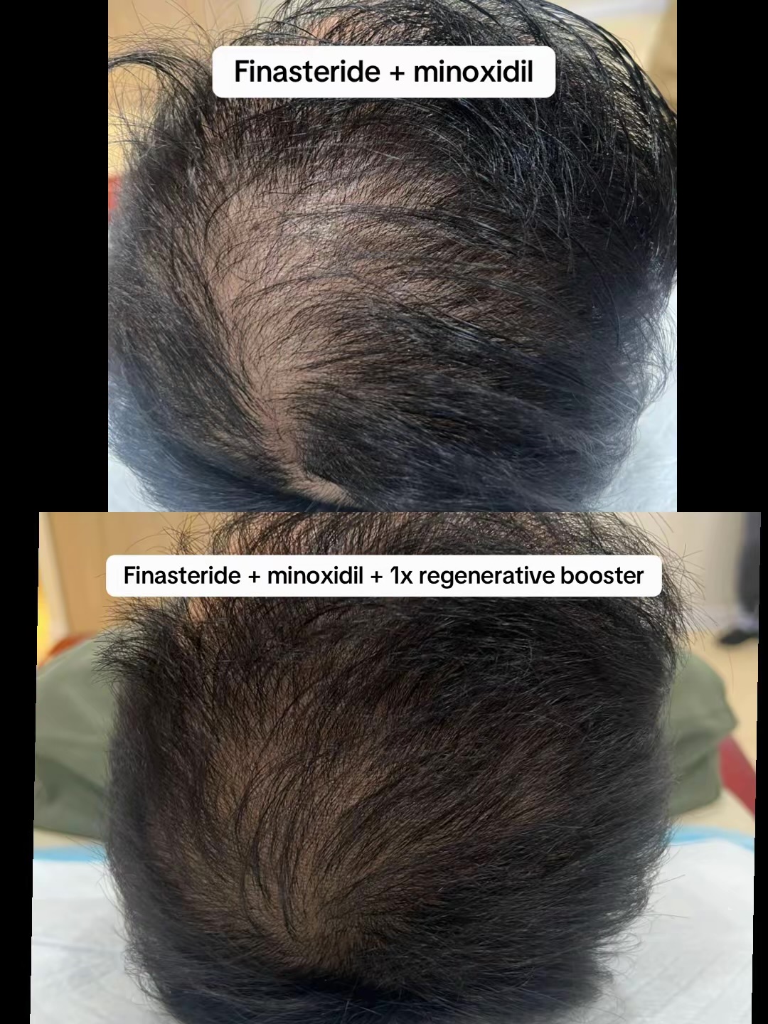 Treatment response timeline showing hair density improvement