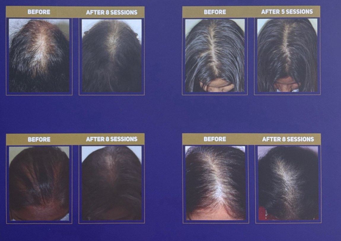 Female hair loss before and after treatment at Thrive Hair Clinic