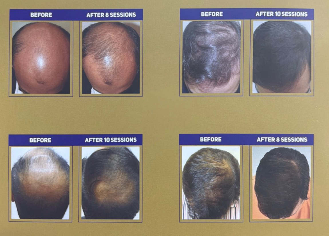 Male pattern hair loss before and after treatment at Thrive Hair Clinic